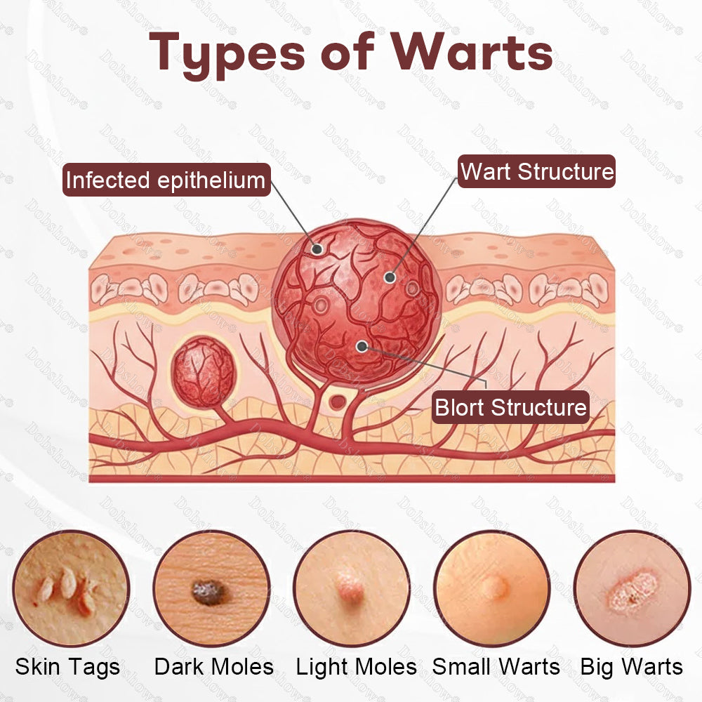 👨‍⚕️🌿Healrize® BlackRice DermCorrect™ Wart Recovery Cream| Suitable for all skin types