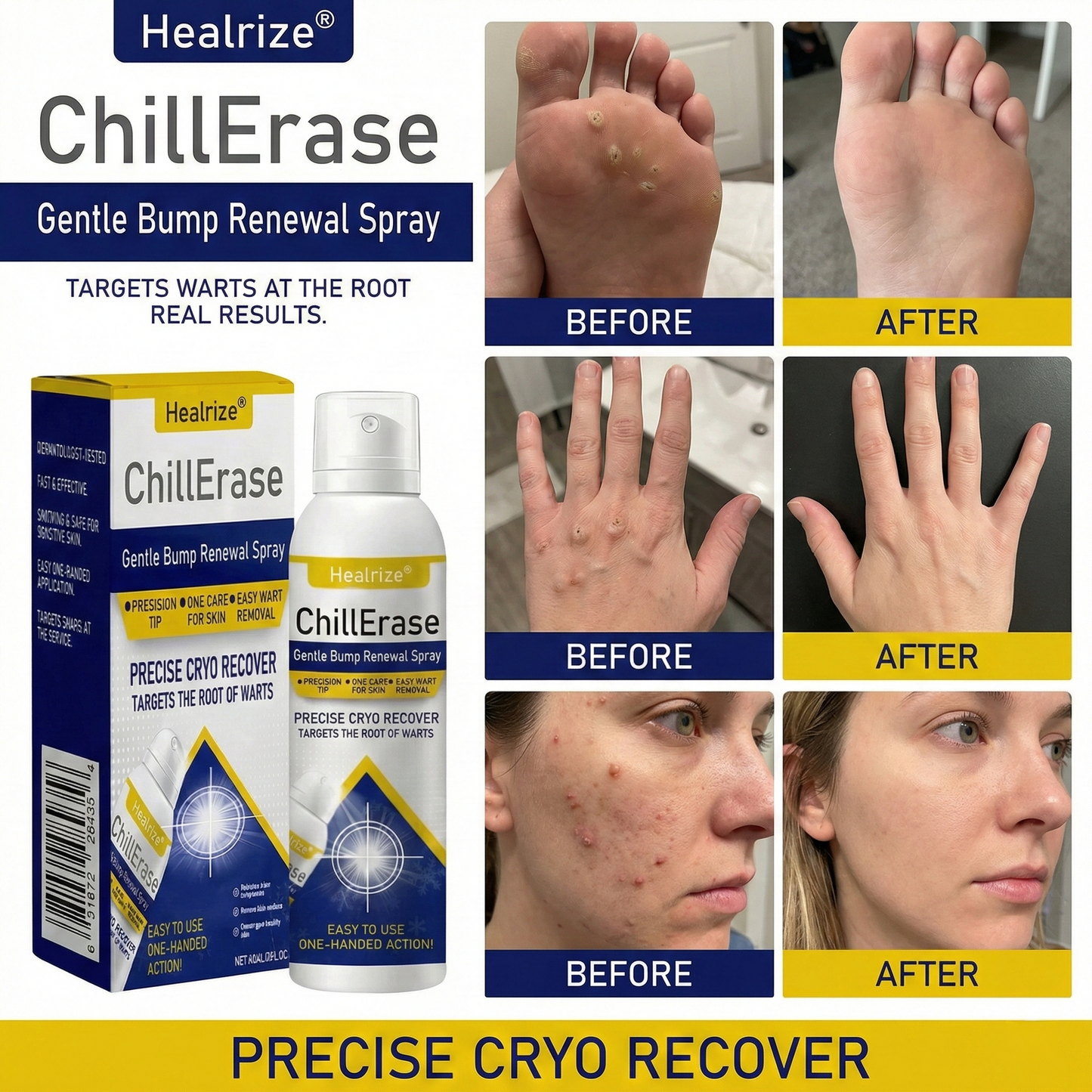 ❄️Healrize®ChillErase Gentle Bump Renewal Spray — Pain-Free, Acid-Free Gentle Wart Removal