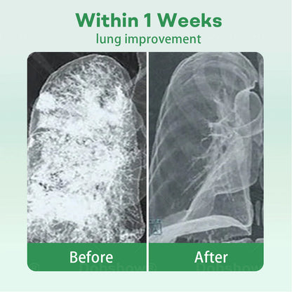 ✅Official Store| Healrize® 𝐇𝐞𝐫𝐛𝐚𝐥 𝐋𝐮𝐧𝐠 𝐂𝐥𝐞𝐚𝐧𝐬𝐢𝐧𝐠 𝐈𝐧𝐡𝐚𝐢𝐞𝐫(🫁Cough, wheezing, shortness of breath, sputum, stuffy nose, bronchitis, bronchitis, allergy symptoms, lung discomfort💝)