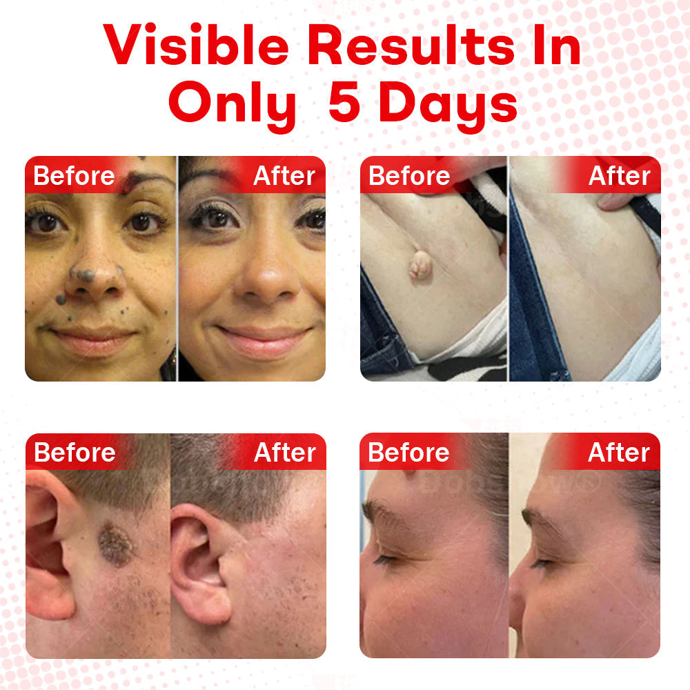 𝐂𝐯𝐫𝐞𝐨𝐳®𝐌𝐢𝐜𝐫𝐨𝐍𝐞𝐞𝐝𝐥𝐞 𝐁𝐨𝐭𝐚𝐧𝐢𝐜𝐒𝐤𝐢𝐧 𝐓𝐚𝐠 𝐑𝐞𝐦𝐨𝐯𝐚𝐥 𝐏𝐚𝐭𝐜𝐡