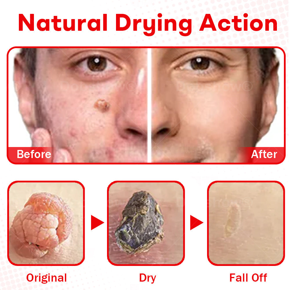 𝐂𝐯𝐫𝐞𝐨𝐳®𝐌𝐢𝐜𝐫𝐨𝐍𝐞𝐞𝐝𝐥𝐞 𝐁𝐨𝐭𝐚𝐧𝐢𝐜𝐒𝐤𝐢𝐧 𝐓𝐚𝐠 𝐑𝐞𝐦𝐨𝐯𝐚𝐥 𝐏𝐚𝐭𝐜𝐡